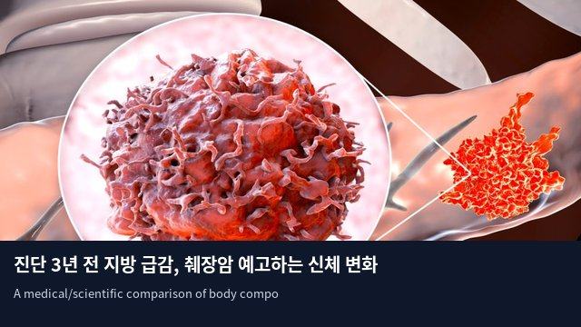 진단 3년 전 지방 급감, 췌장암 예고하는 신체 변화