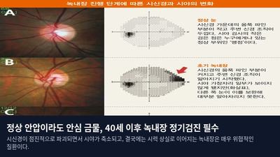 정상 안압이라도 안심 금물, 40세 이후 녹내장 정기검진 필수