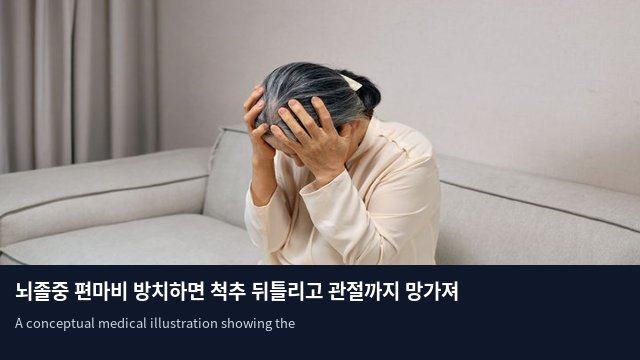 뇌졸중 편마비 방치하면 척추 뒤틀리고 관절까지 망가져